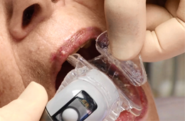 Mouthpiece Placement