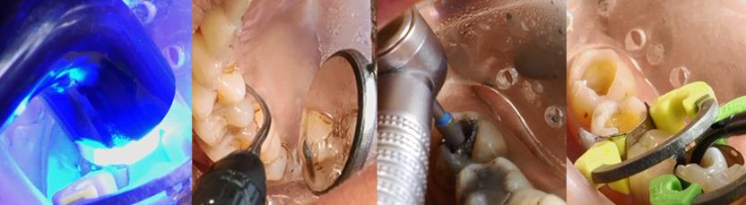 How isolite is used in dental practices How isolite is used in dental practices