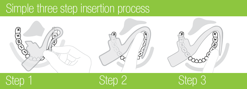 Mouthpiece Insertion Mouthpiece Insertion